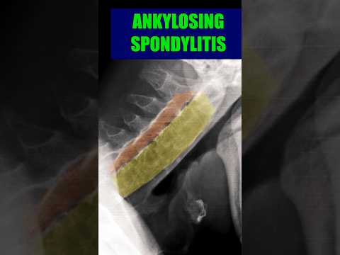Syndesmophytes in Radiology: Advances and Clinical Insights