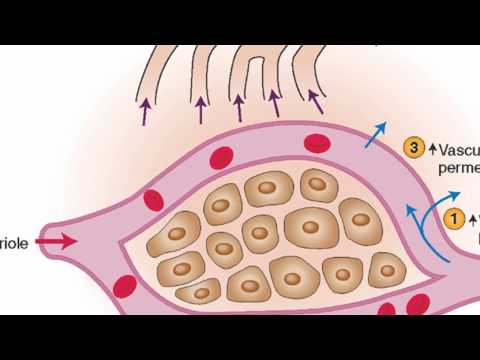 The Science Behind Edema Physiology and Its Mechanisms