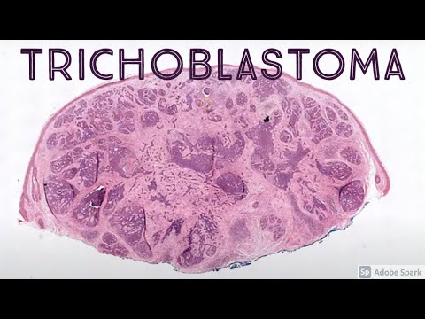 Trichoepithelioma Pathology: Insights and Advances in Research