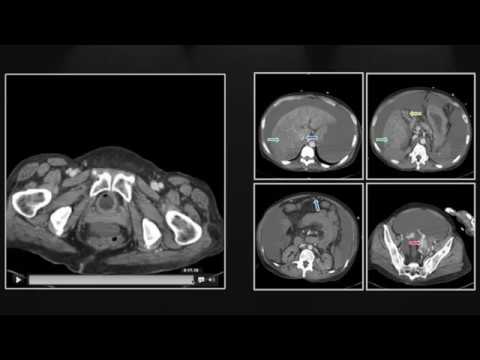 Advancements in Radiology for Diagnosing Cirrhosis