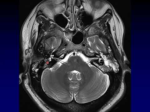 Advances in Radiology for Diagnosing Mastoiditis