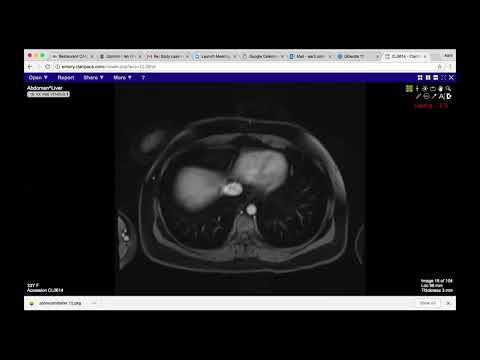 Biliary Cystadenoma: Radiologic Features and Diagnosis