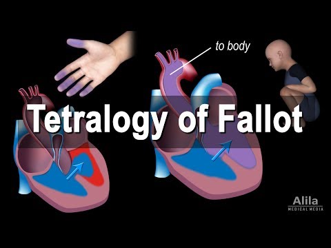Pathophysiology of Tetralogy of Fallot in Clinical Context