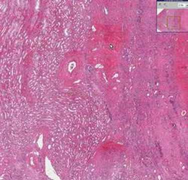 Wilms Tumor Histology Insights for Scientific Outreach