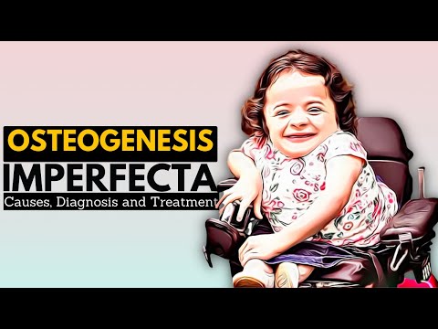 Osteogenesis Imperfecta: Unraveling Its Pathophysiology