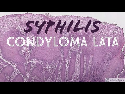 Condyloma Pathology Insights for Scientific Outreach