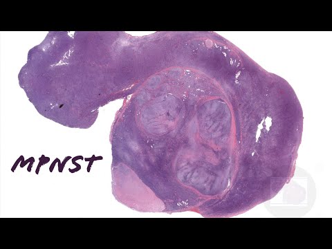 MPNST Pathology Outlines and Implications for Research