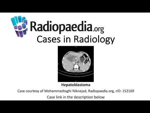 Advancements in Radiology for Hepatoblastoma Diagnosis