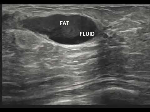 Radiological Insights into Galactocele Diagnosis and Management
