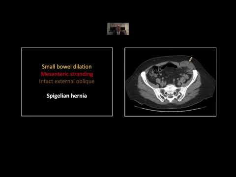 Radiological Advances in Diagnosing Malrotation Cases