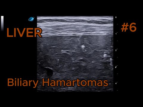 Advances in Biliary Hamartoma Imaging Techniques