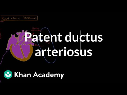 Pathophysiology of Patent Ductus Arteriosus in Neonates