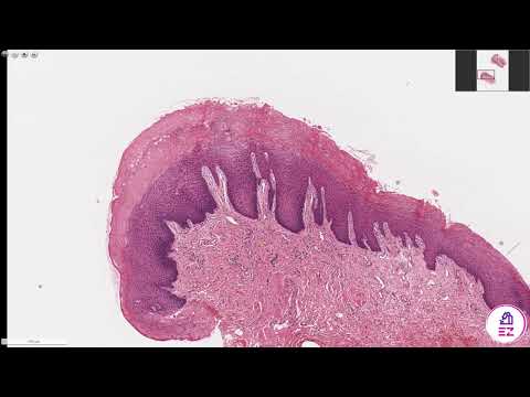 Hyperkeratosis Histology: Insights into Skin Pathology