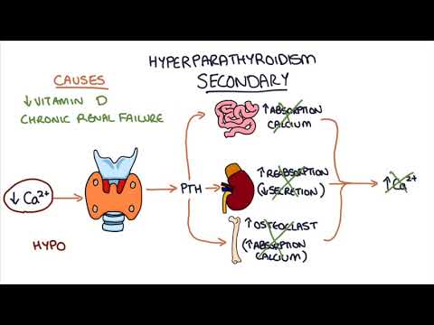 Hyperparathyroidism Pathophysiology and Its Clinical Implications