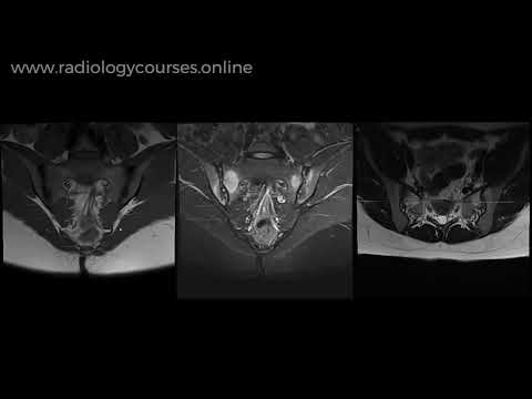 Advances in Radiology for Diagnosing Sacroiliitis