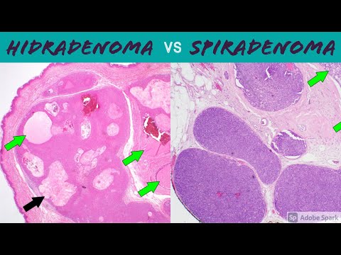 Hidradenoma Pathology: Insights and Clinical Significance