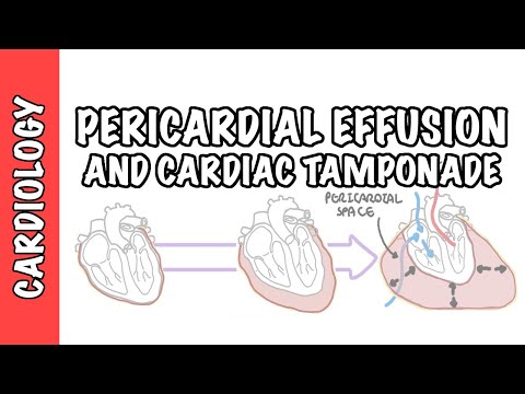 Cardiac Tamponade Physiology and Its Clinical Implications