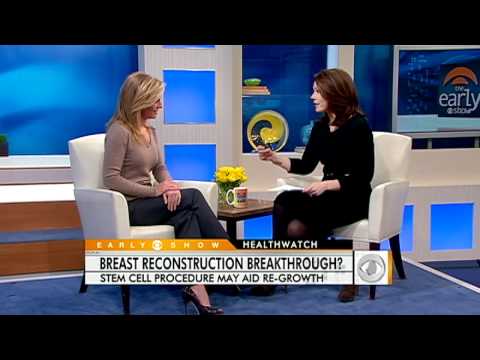 Advancements in Stem Cell Techniques for Breast Augmentation