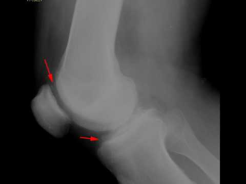 Radiological Insights into Chondrocalcinosis Pathology
