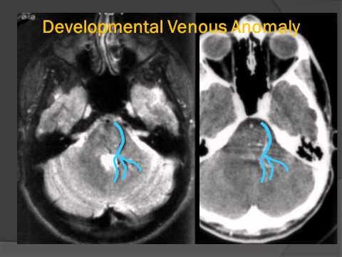Advancements in Radiology of Developmental Venous Anomalies