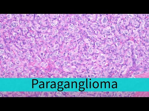Paraganglioma Pathology Insights for Scientific Outreach