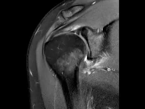 Radiological Insights into Adhesive Capsulitis Diagnosis