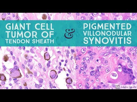 Pathological Features of Giant Cell Tumor of Tendon Sheath