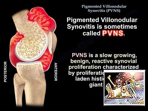 Pathology of Pigmented Villonodular Synovitis Uncovered
