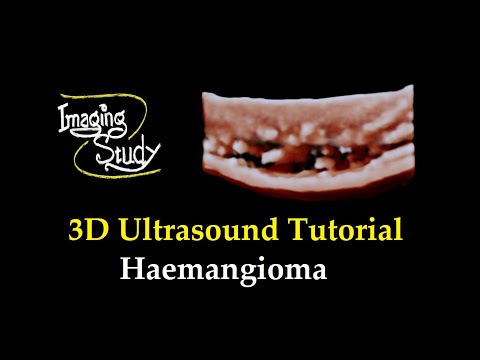 Advances in Hemangioma Imaging Techniques and Findings