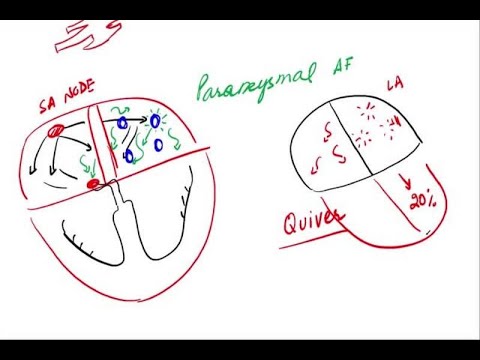 Pathophysiology of Atrial Fibrillation: Mechanisms and Insights