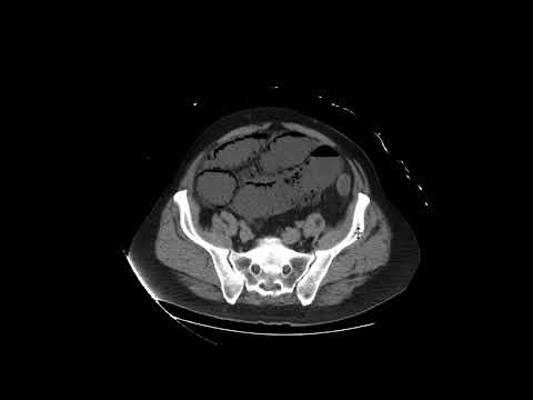 Innovations in Radiology for Mesenteric Ischemia Diagnosis
