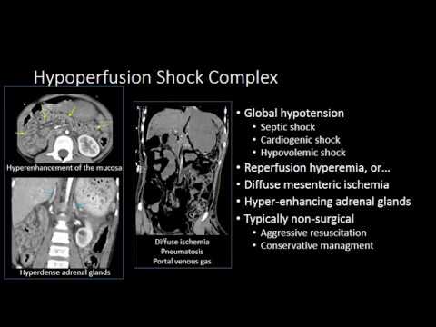 Advancements in Radiology for Diagnosing Bowel Ischemia
