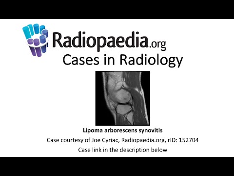Radiological Features of Lipoma Arborescens in Clinical Practice