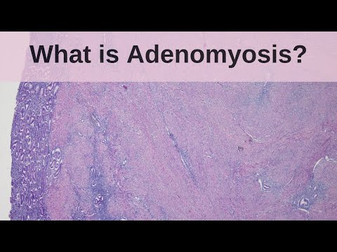 Histological Insights into Adenomyosis Pathology