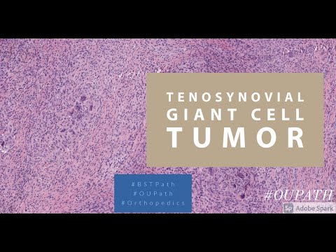 Tenosynovial Giant Cell Tumor Pathology Insights and Implications