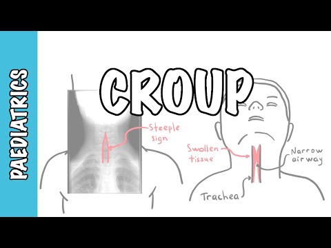 Croup Pathophysiology: Key Mechanisms and Implications