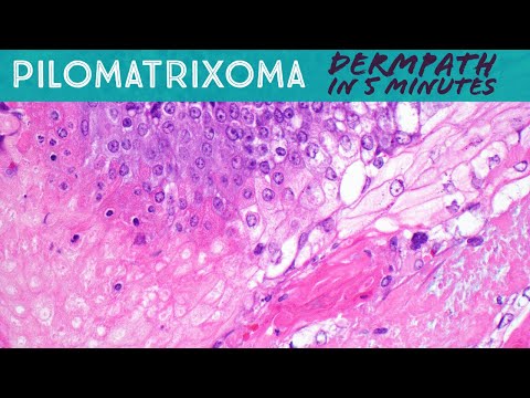 Pilomatricoma Pathology: Key Characteristics and Insights