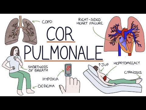 Pathophysiology of Cor Pulmonale: Unraveling Heart and Lung Links