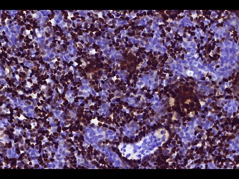 Pathological Insights into Spiradenoma Tumors and Features