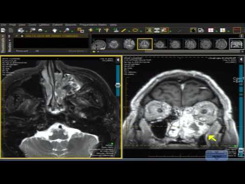 Radiological Insights into Inverted Papilloma Diagnosis