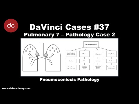 Histological Insights into Silicosis Pathology and Research