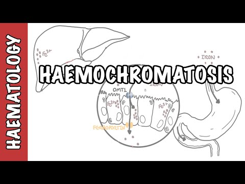 Pathophysiology of Hemochromatosis and its Clinical Implications