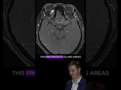MRI Insights into Hemangiomas: Advancements in Diagnosis