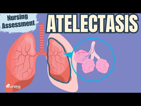 Atelectasis Pathophysiology and Its Implications in Medicine