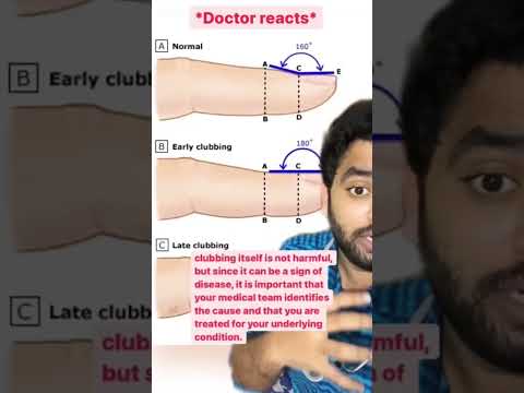 Pathophysiology of Clubbing: Insights and Implications