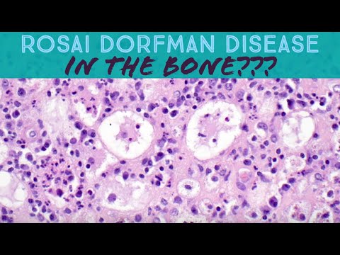 Rosai Dorfman Pathology Insights for Scientific Education