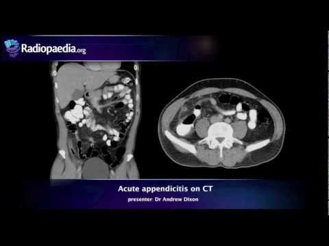 Advances in Radiology for Diagnosing Appendicitis