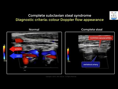 Subclavian Steal Syndrome and its Radiological Implications