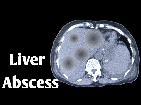 Radiological Insights into Liver Abscess Diagnosis and Treatment