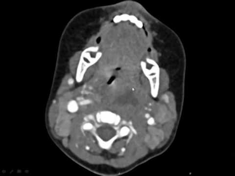 Retropharyngeal Abscess: Advances in Radiological Imaging